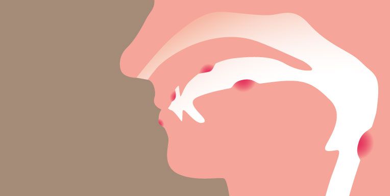 Ilustración de perfil bucal y nasal de paciente con cáncer en la boca