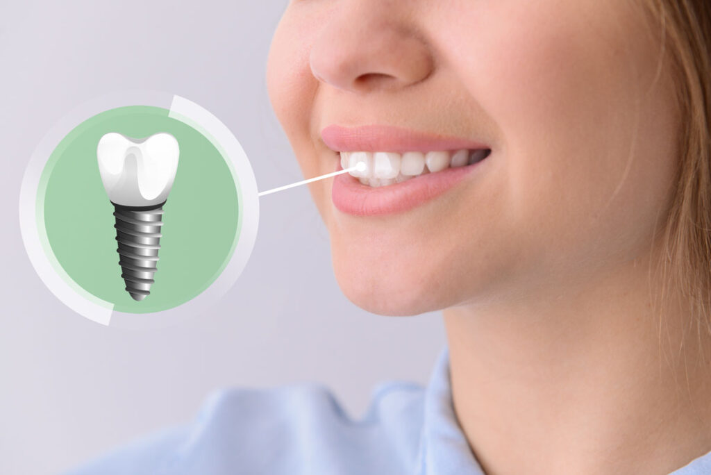 cuidar implantes dentales