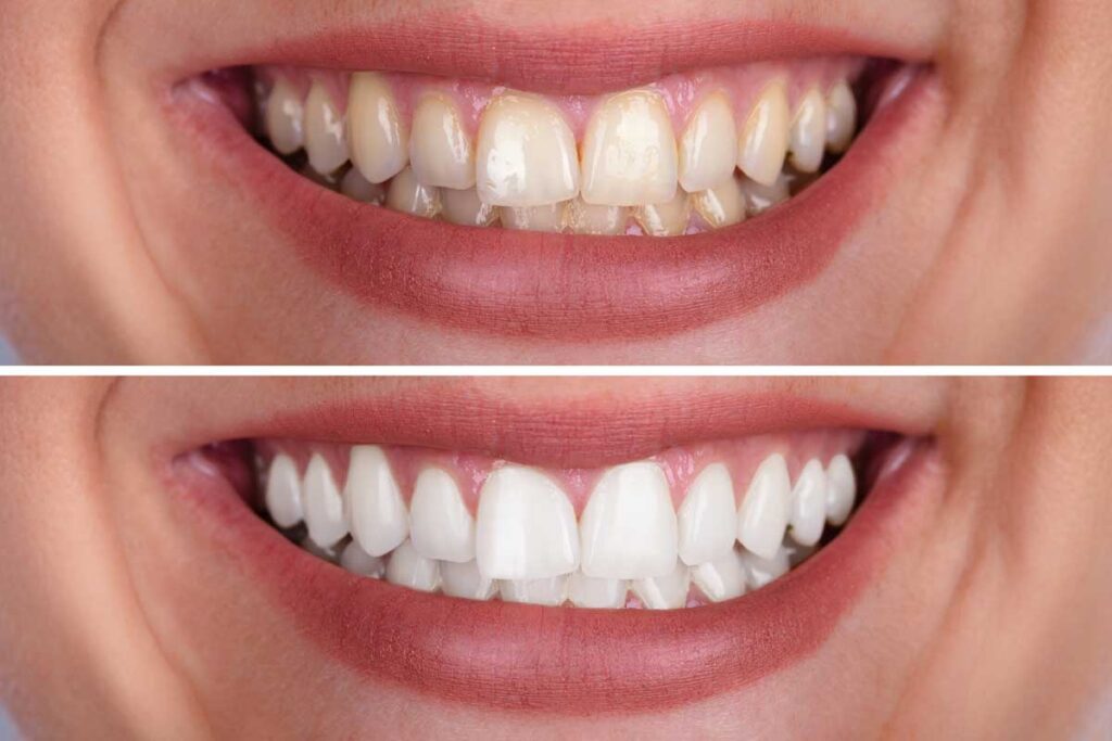 Blanqueamiento dental en casa o en clínica comparado en Palomo Luque Odontólogos