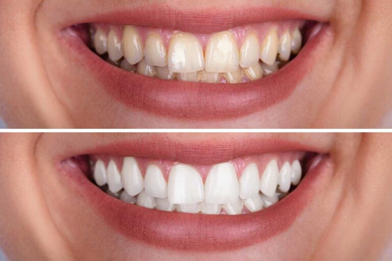 Blanqueamiento dental en casa o en clínica comparado en Palomo Luque Odontólogos