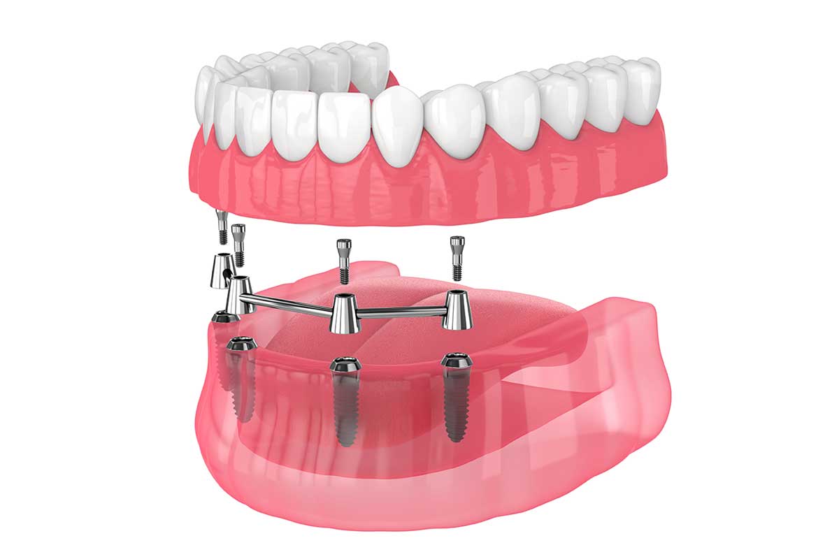 sobredentadura-con-barra-implantes-dentales-en-m-laga