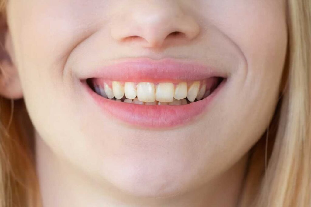 paciente mostrando sonrisa con manchas en los dientes