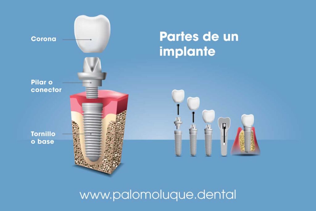 Partes de un implante dental
