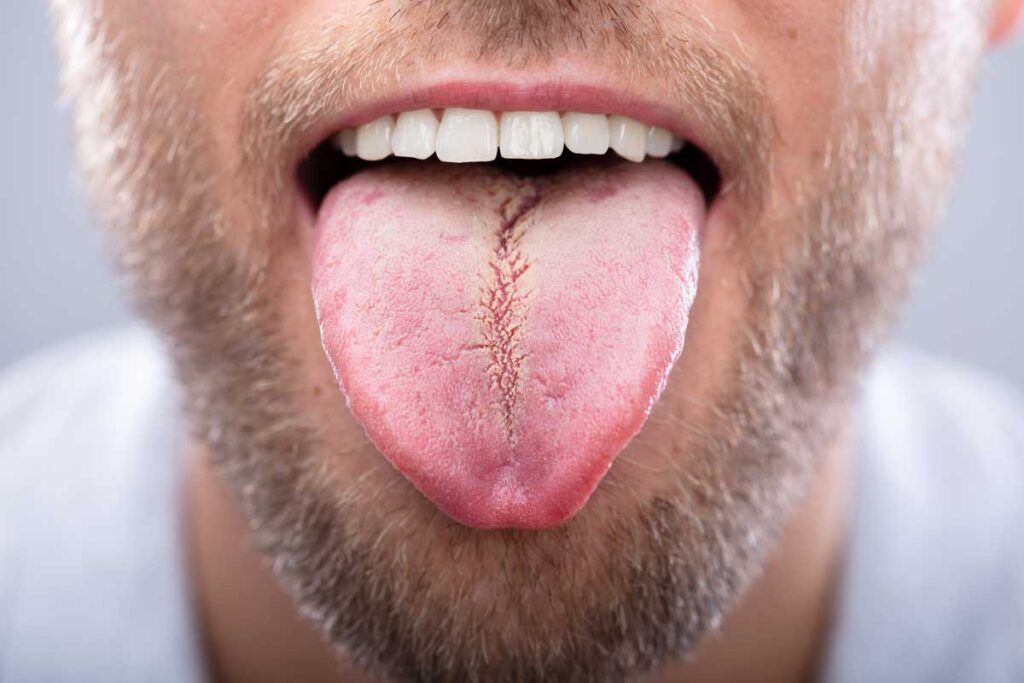 hombre mostrando su lengua blanca