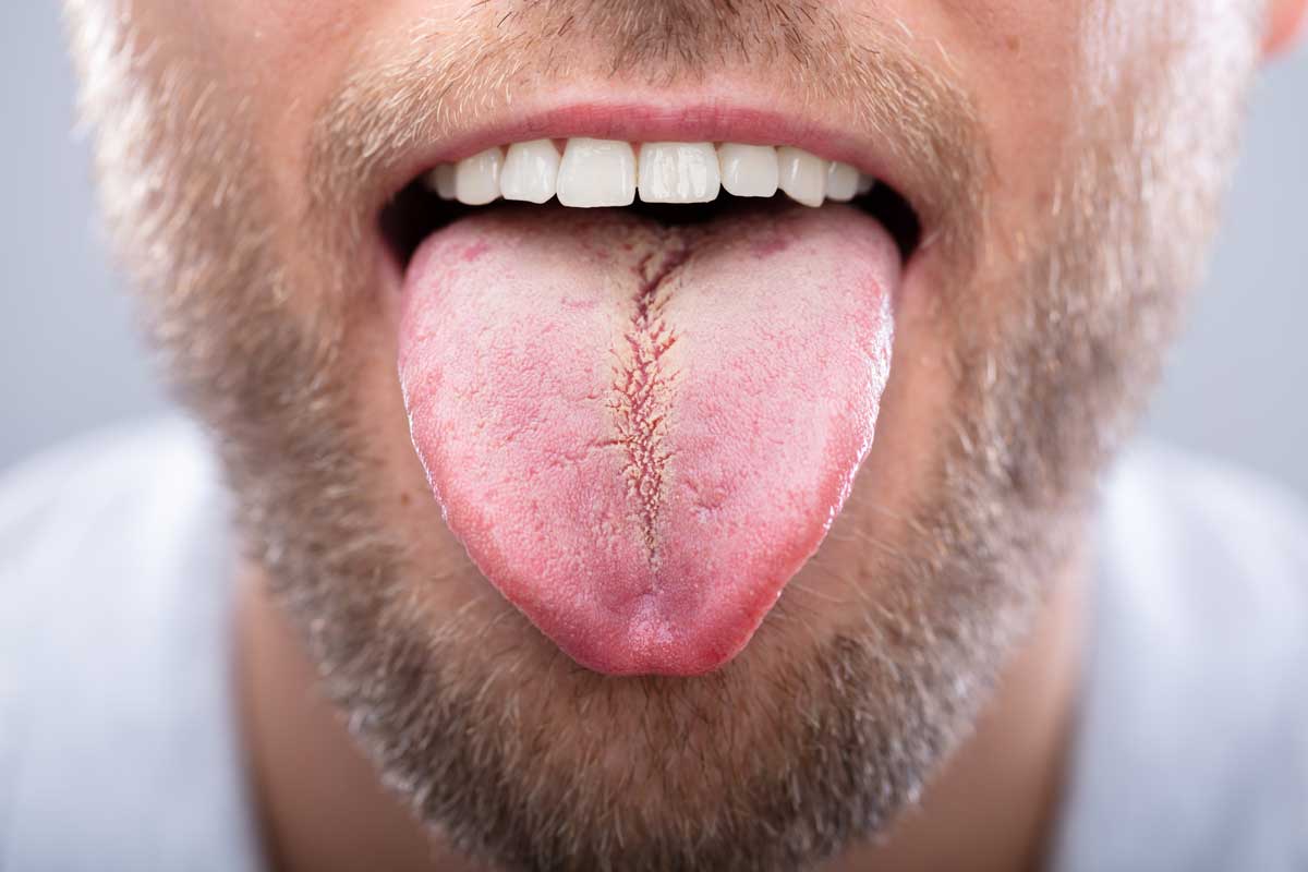 hombre mostrando su lengua blanca