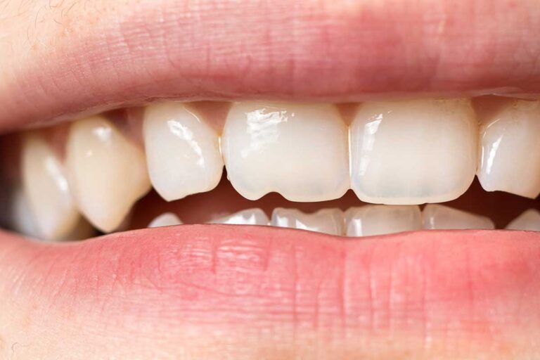 dentadura con erosión dental