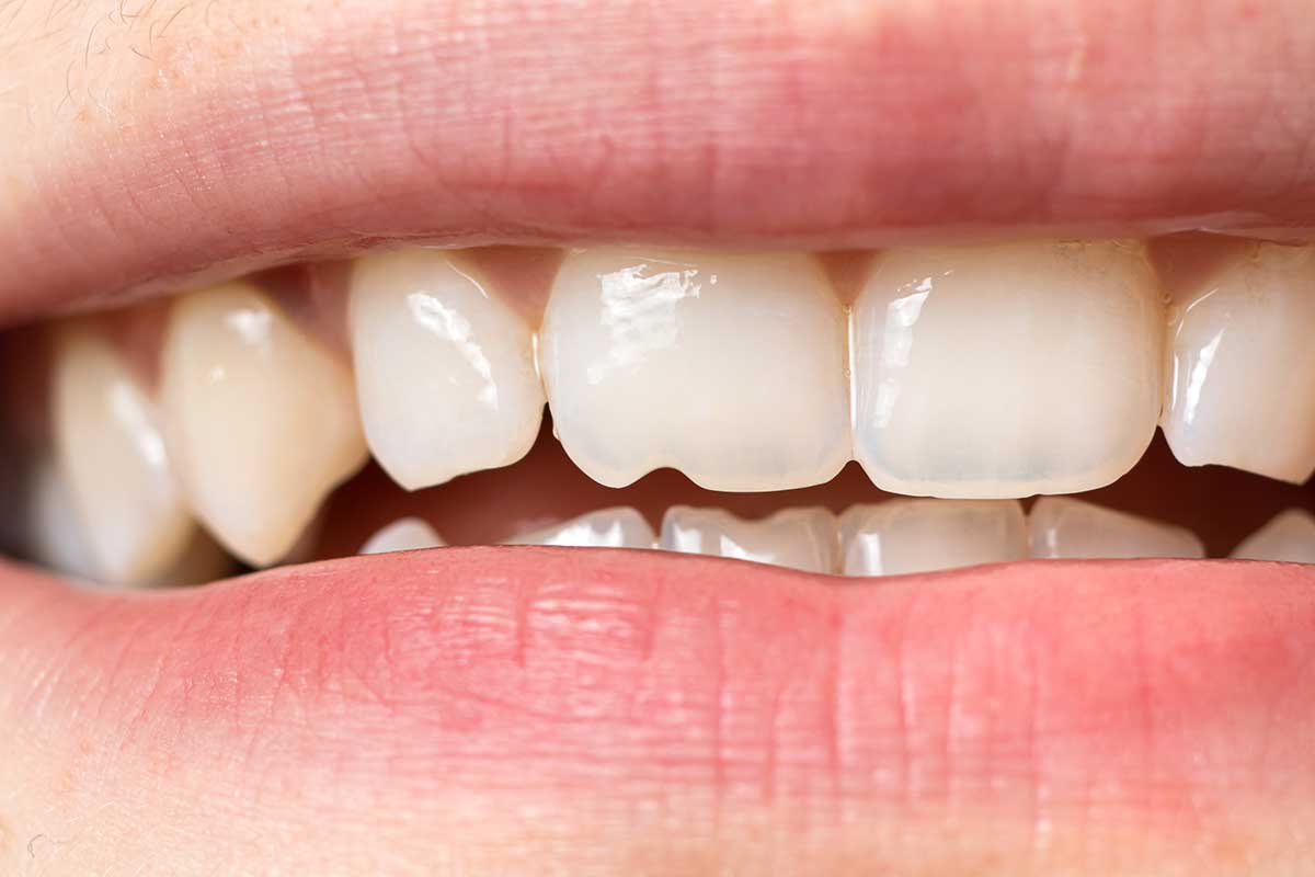 dentadura con erosión dental