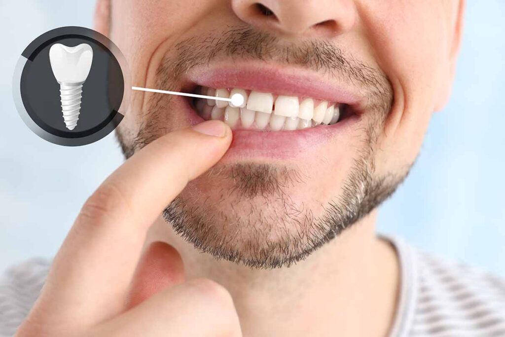 Periimplantitis: inflamación y sangrado alrededor del implante dental
