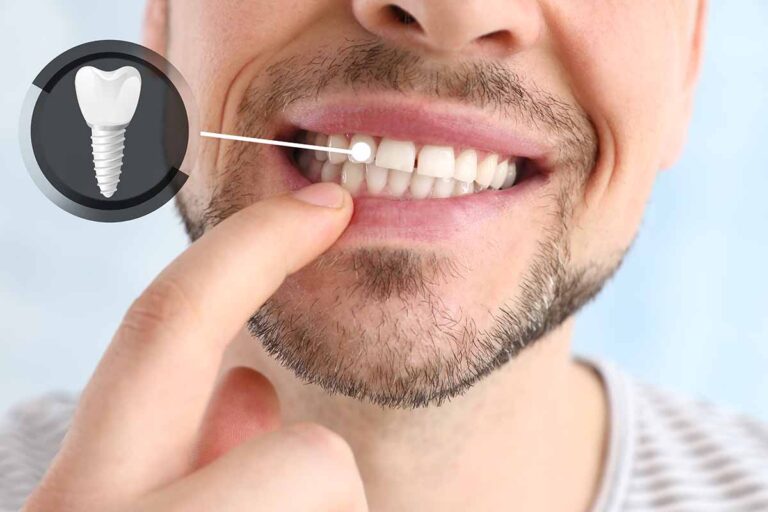 Periimplantitis: inflamación y sangrado alrededor del implante dental