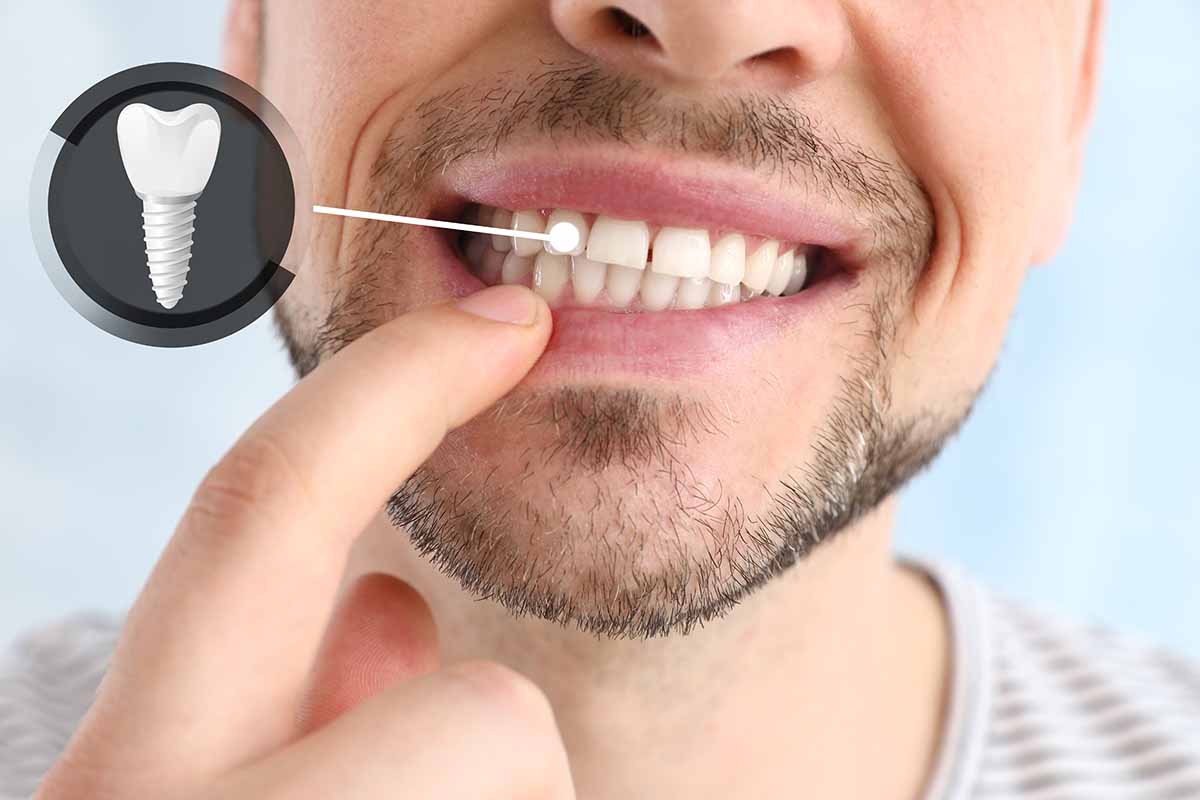 Periimplantitis: inflamación y sangrado alrededor del implante dental