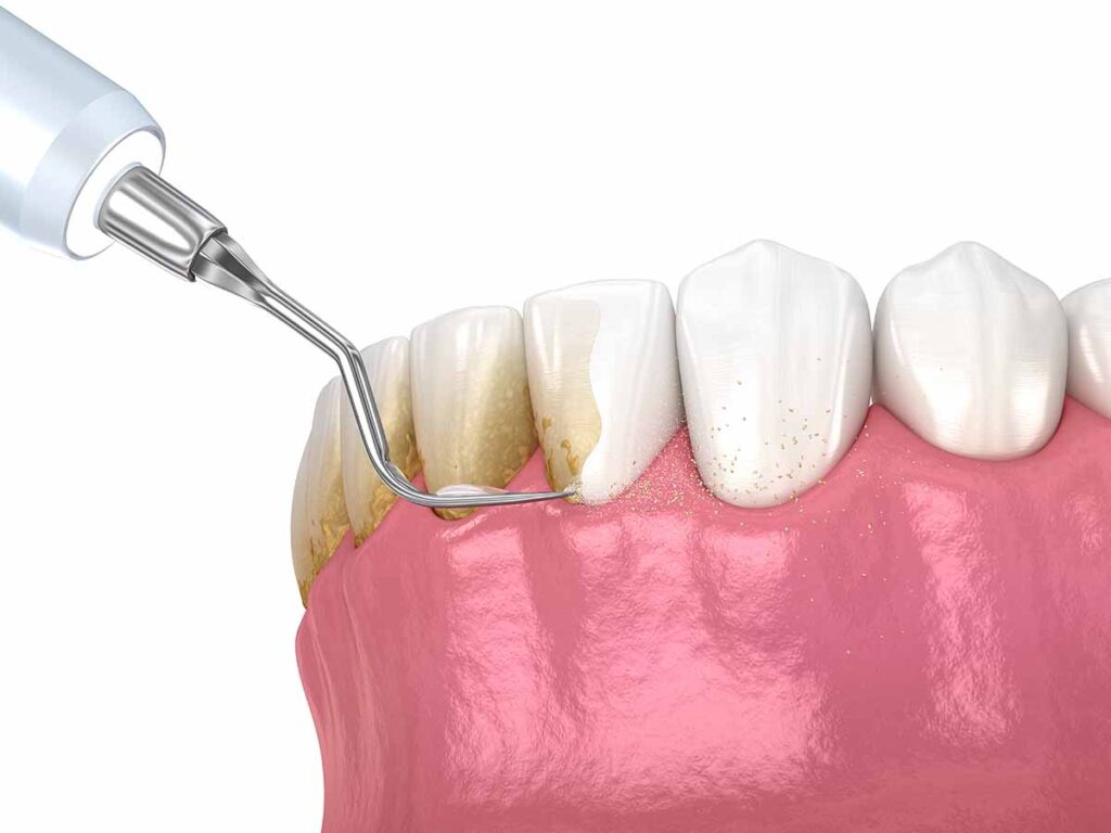 Curetaje dental para piorrea: limpieza profunda bajo la encía