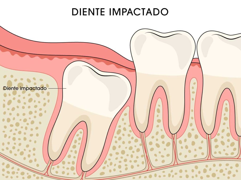 diente impactado