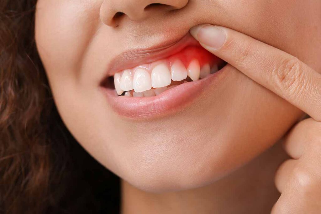 enfermedad periodontal encías inflamadas