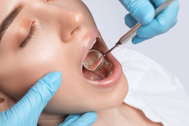 caries interdental entre dos dientes detectada en revisión dental