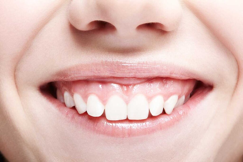 sonrisa gingival antes de tratamiento dental estético