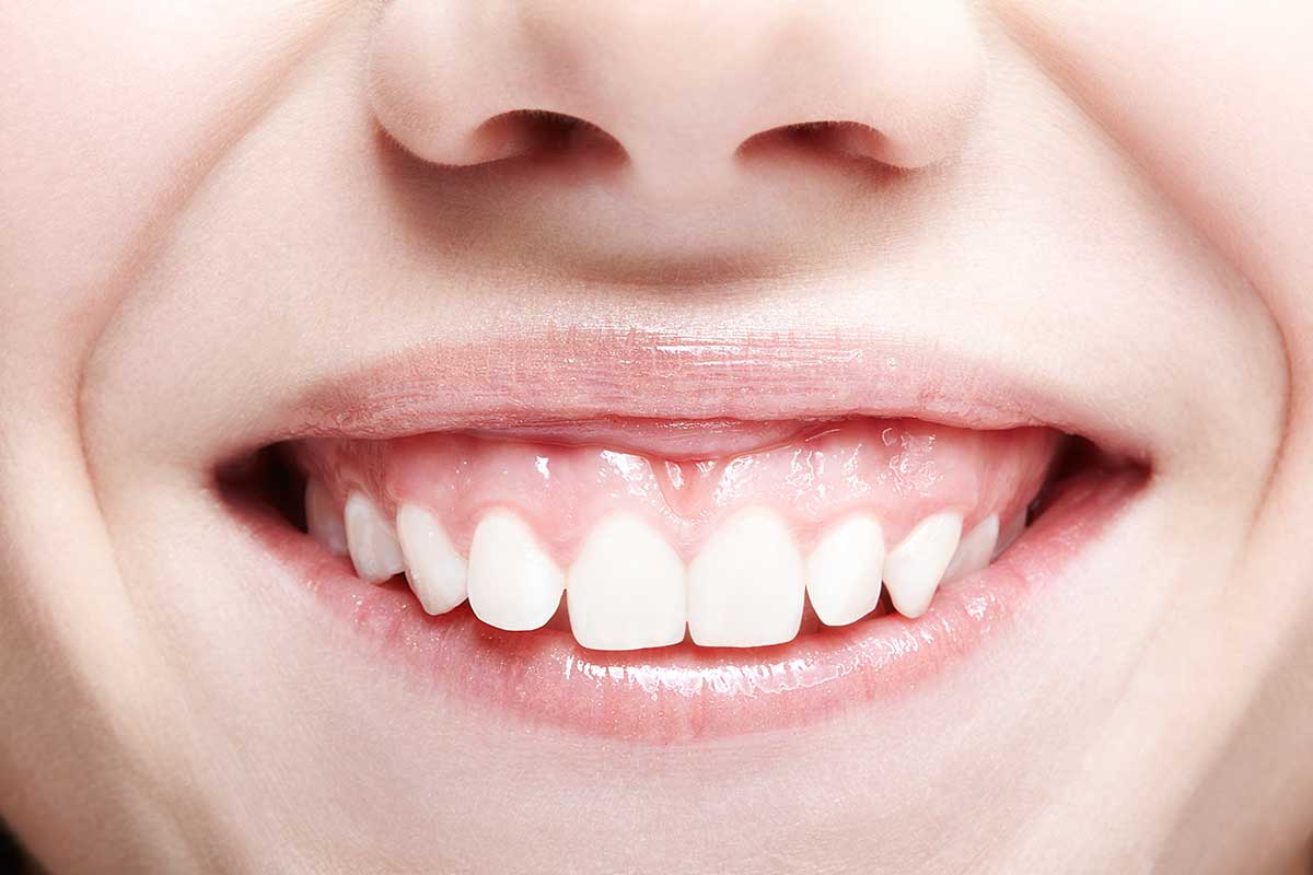 sonrisa gingival antes de tratamiento dental estético