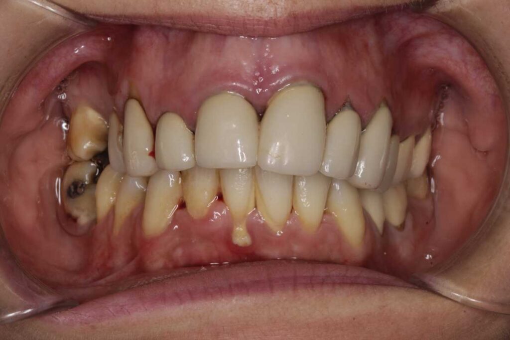 Antes