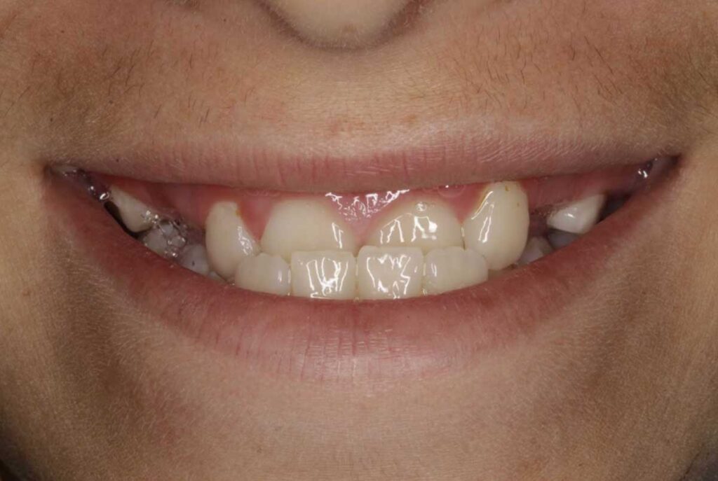 Antes