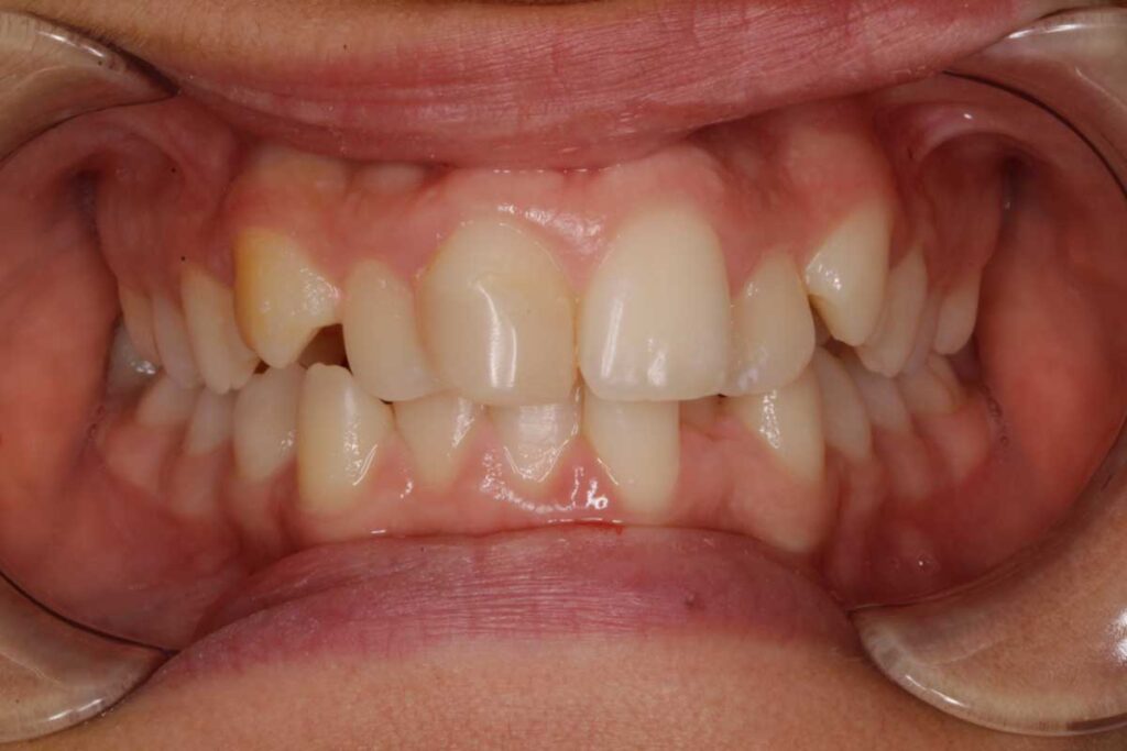Antes