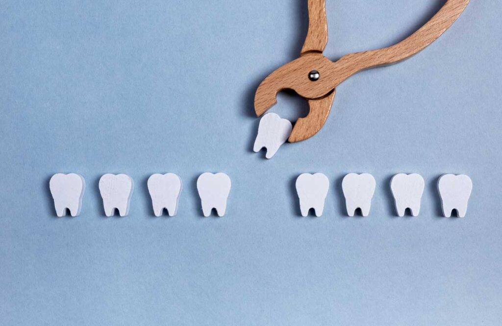extracción dental en málaga