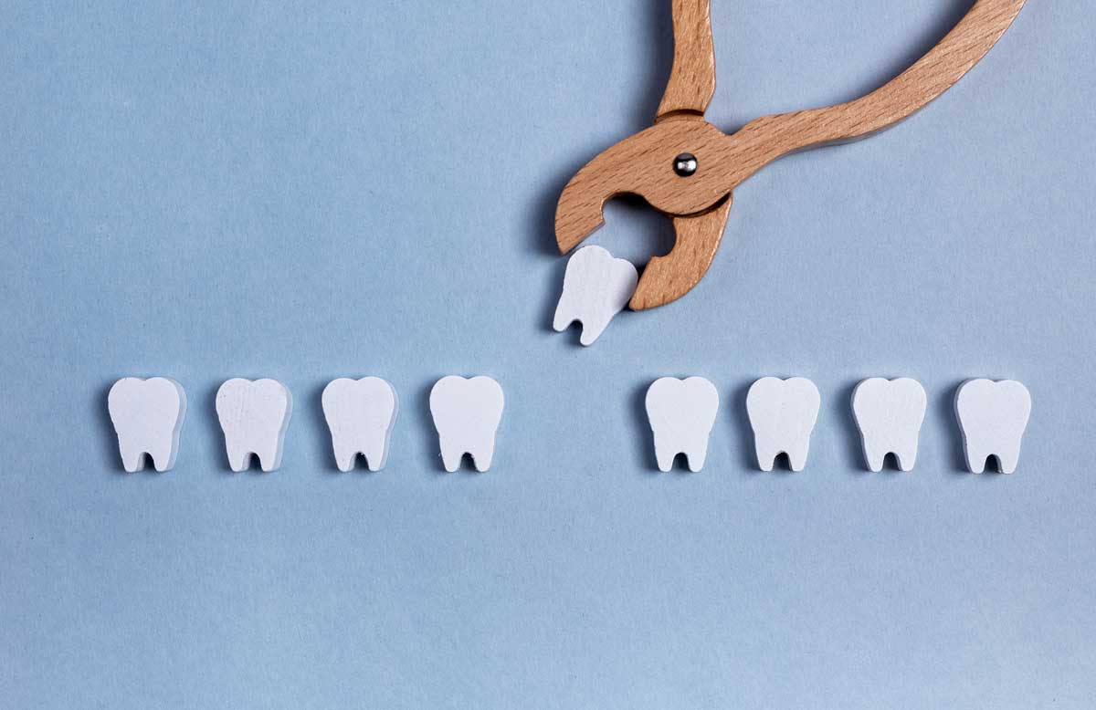 extracción dental en málaga