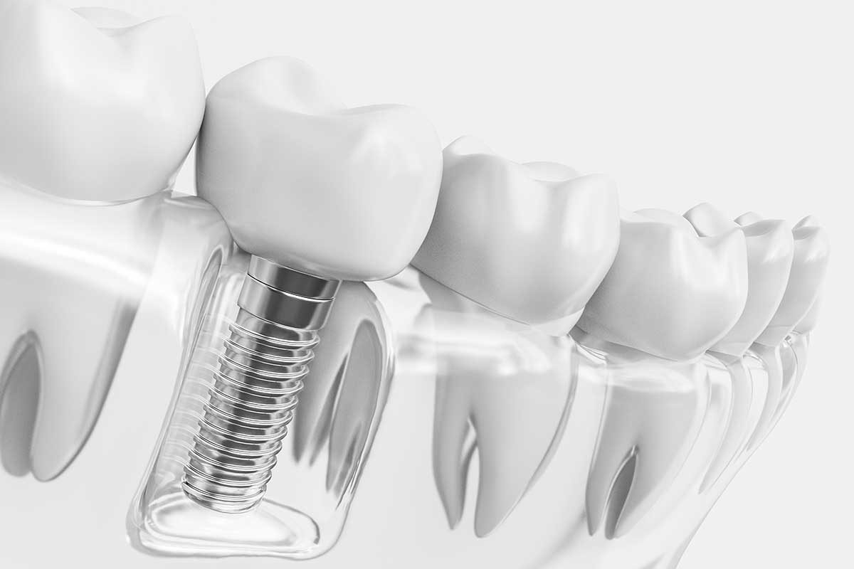 implantes de carga inmediata malaga