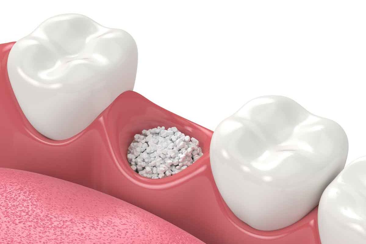 Regeneración ósea dental málaga
