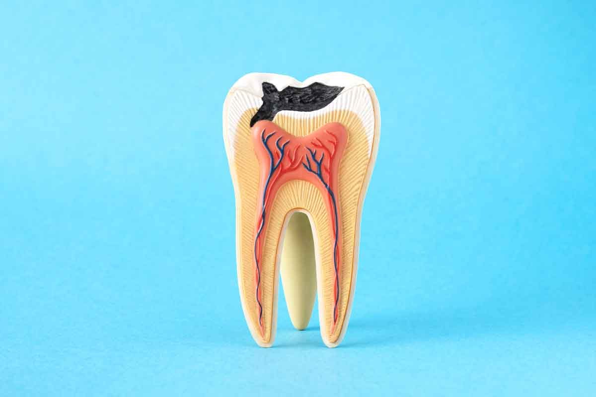 tratamiento-caries-dental-malaga